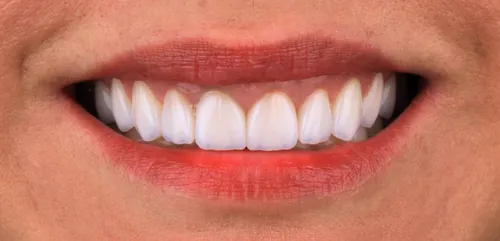 Depois - Dentes Amarelados